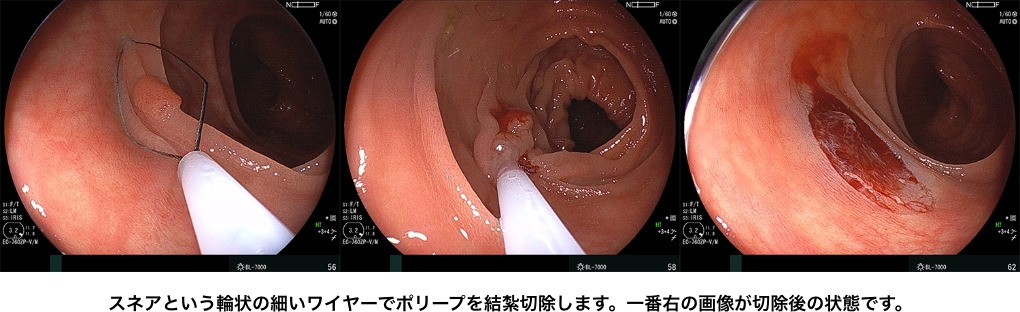 大腸ポリープ切除術（コールドスネアポリペクトミー）