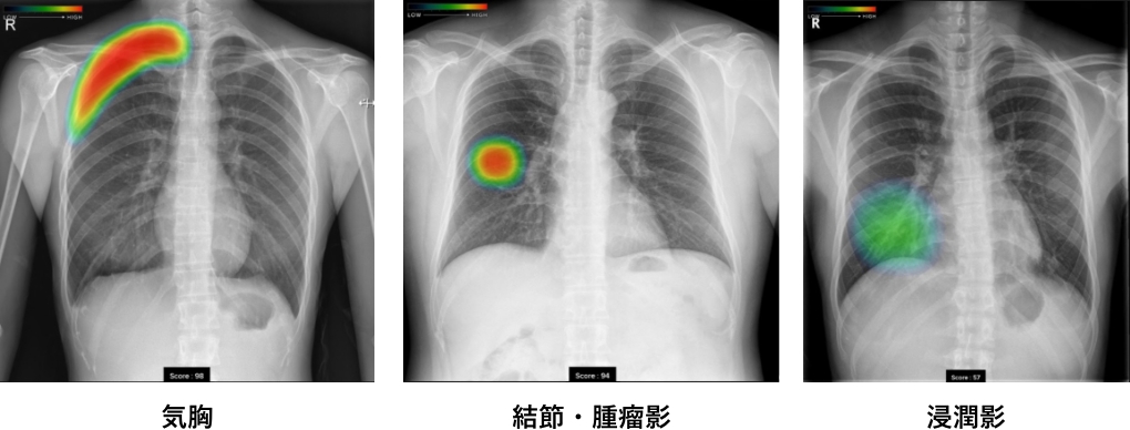 AI診断　胸部単純X線画像診断